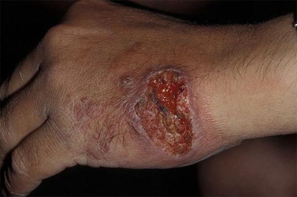 صحيفة بريطانية : وباء اللشمانيا الجلدي سيعجل بنهاية داعش وباء اللشمانيا الجلدي watanserb.com