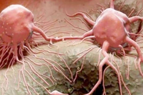 زوج يهتم بعلاج زوجته المريضة بالسرطان ويفاجئ بإصابته بنفس المرض وينتقل إلى رحمته الرعاية الصحية لمرضى السرطان watanserb.com