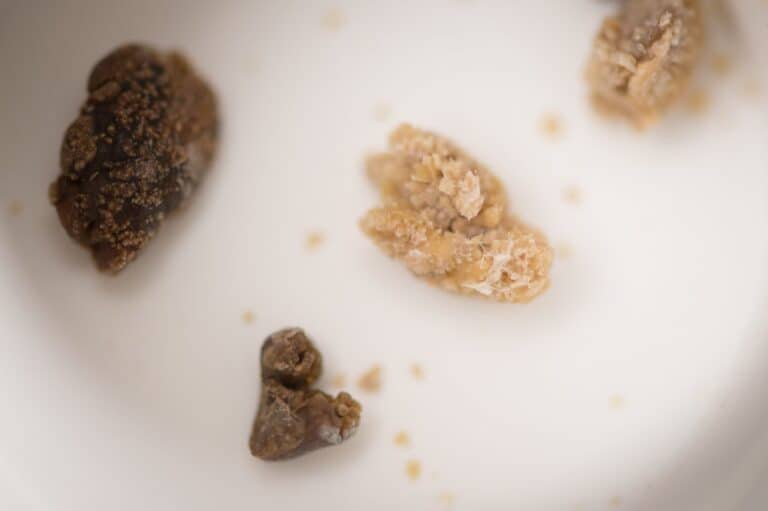 حصوات الكلى watanserb.com