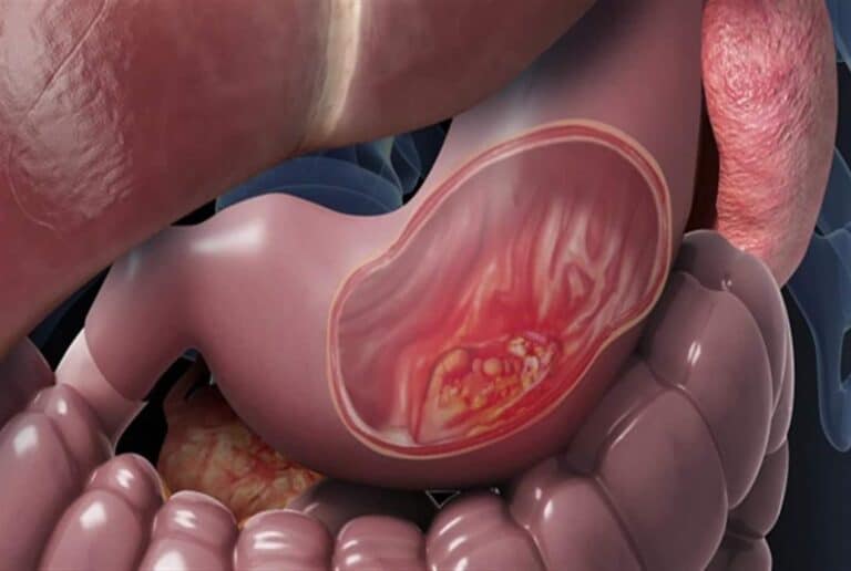 سرطان المعدة watanserb.com