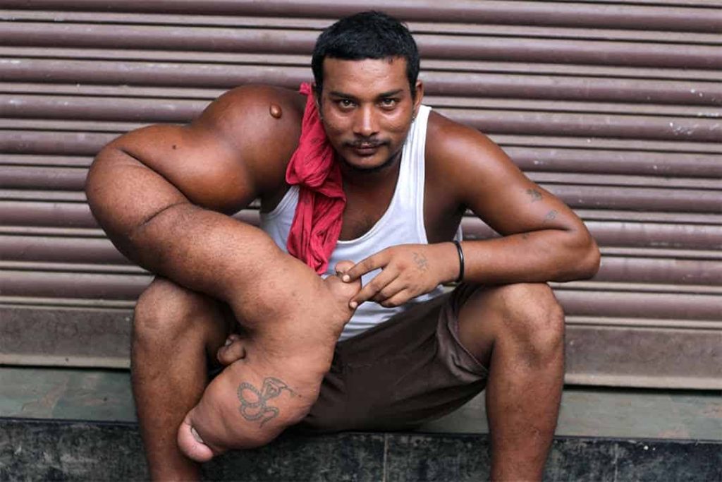 مرض جيني نادر يجعل يد هذا الشّاب تتعملق لحد لا يصدق! | القصة الكاملة مرض جيني نادر يجعل يد هذا الشّاب تتعملق لحد لا يصدق!