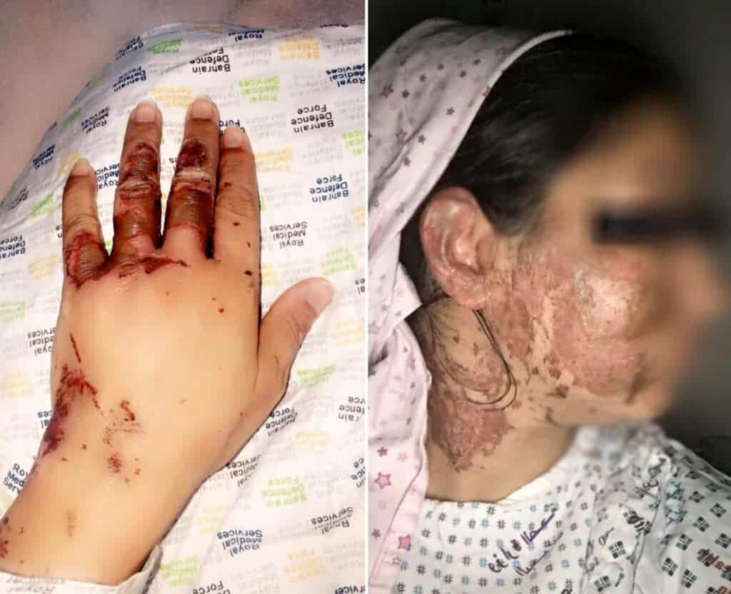 بحريني يحرق زوجته بالأسيد ويحاول اغتصابها