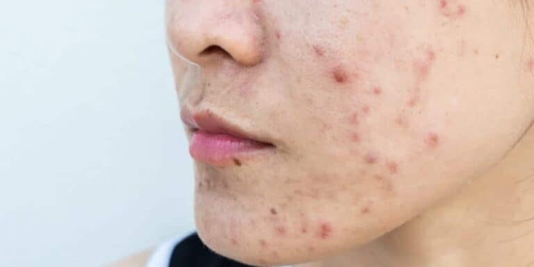 حب الشباب watanserb.com