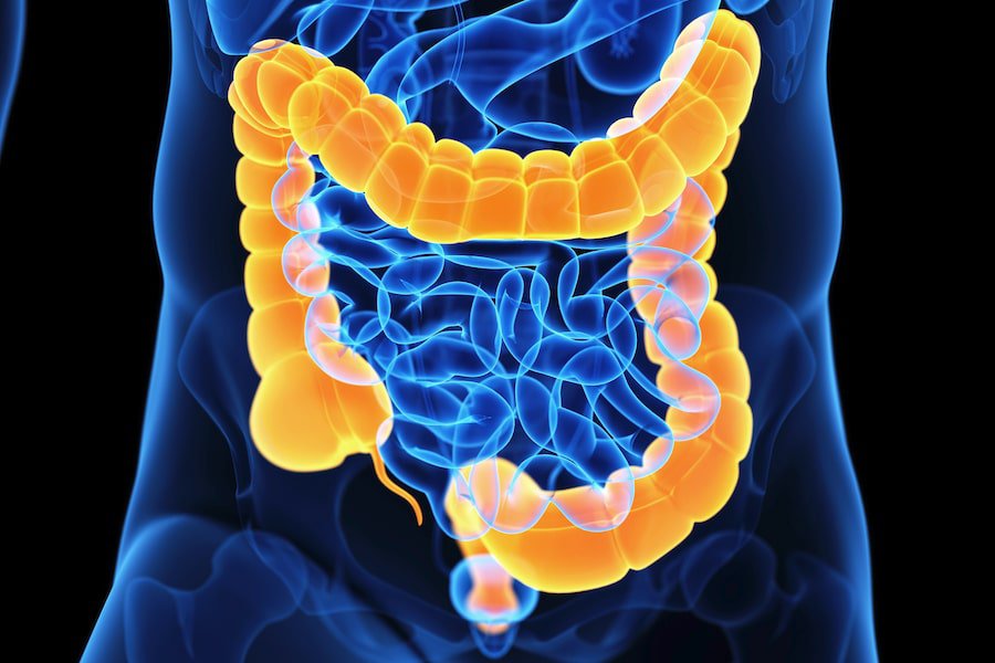 التهاب القولون التقرحي حالة مرضية مزمنة