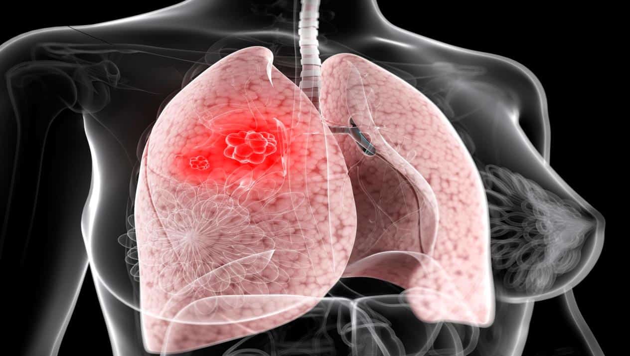 تدمير الرئتين بسبب سرطان الرئة