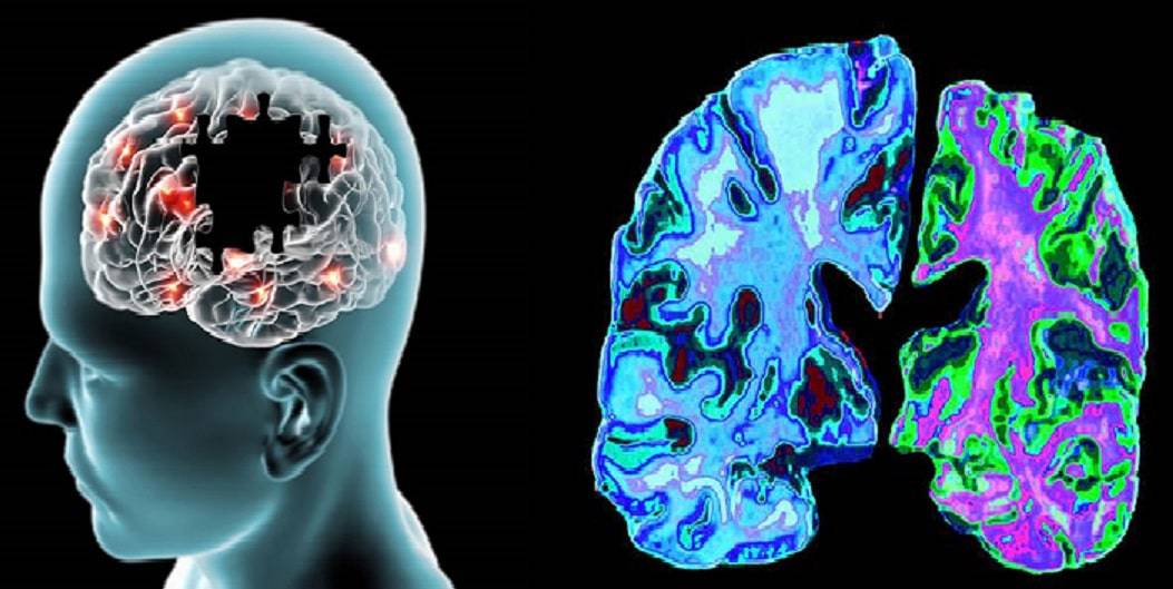 أكّدت منظمة البلدان الأمريكية، عدم وجود علاج لمرض الزهايمر حتى الآن