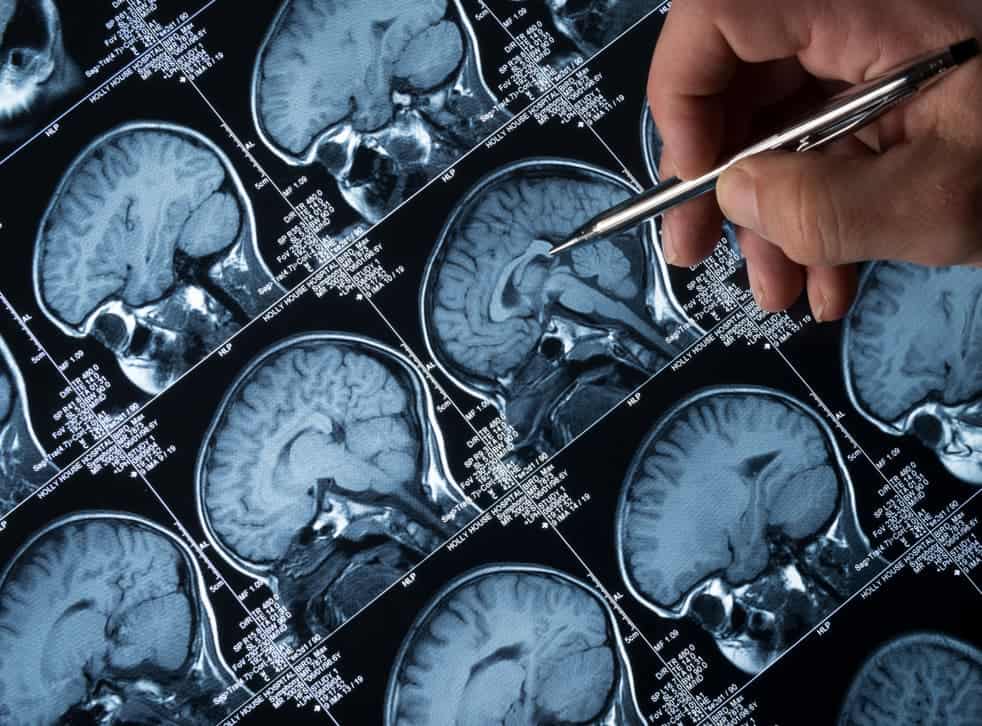 عامل التغذية العصبية المشتق من الدماغ