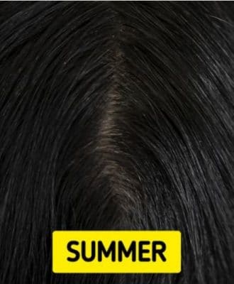 مشكلة تساقط الشعر شائعة بشكل خاص في فصل الخريف