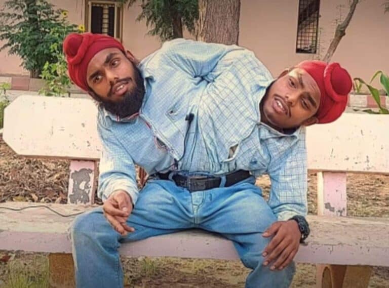 توأمان ملتصقان هجرهما والداهما عند الولادة watanserb.com