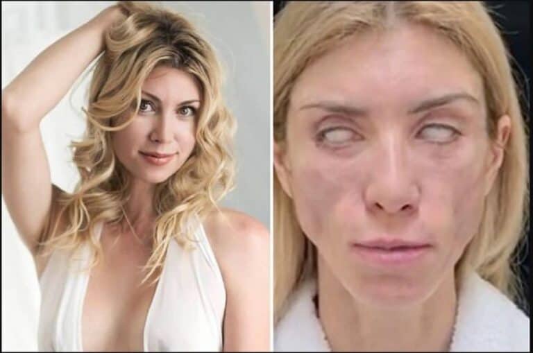 فشل عملية تجميل يحول وجه ملكة جمال إلى كابوس بعد تجاربها في العيادة الرفيعة عملية تجميل تدمر وجه ملكة جمال بشكل غير متوقع watanserb.com