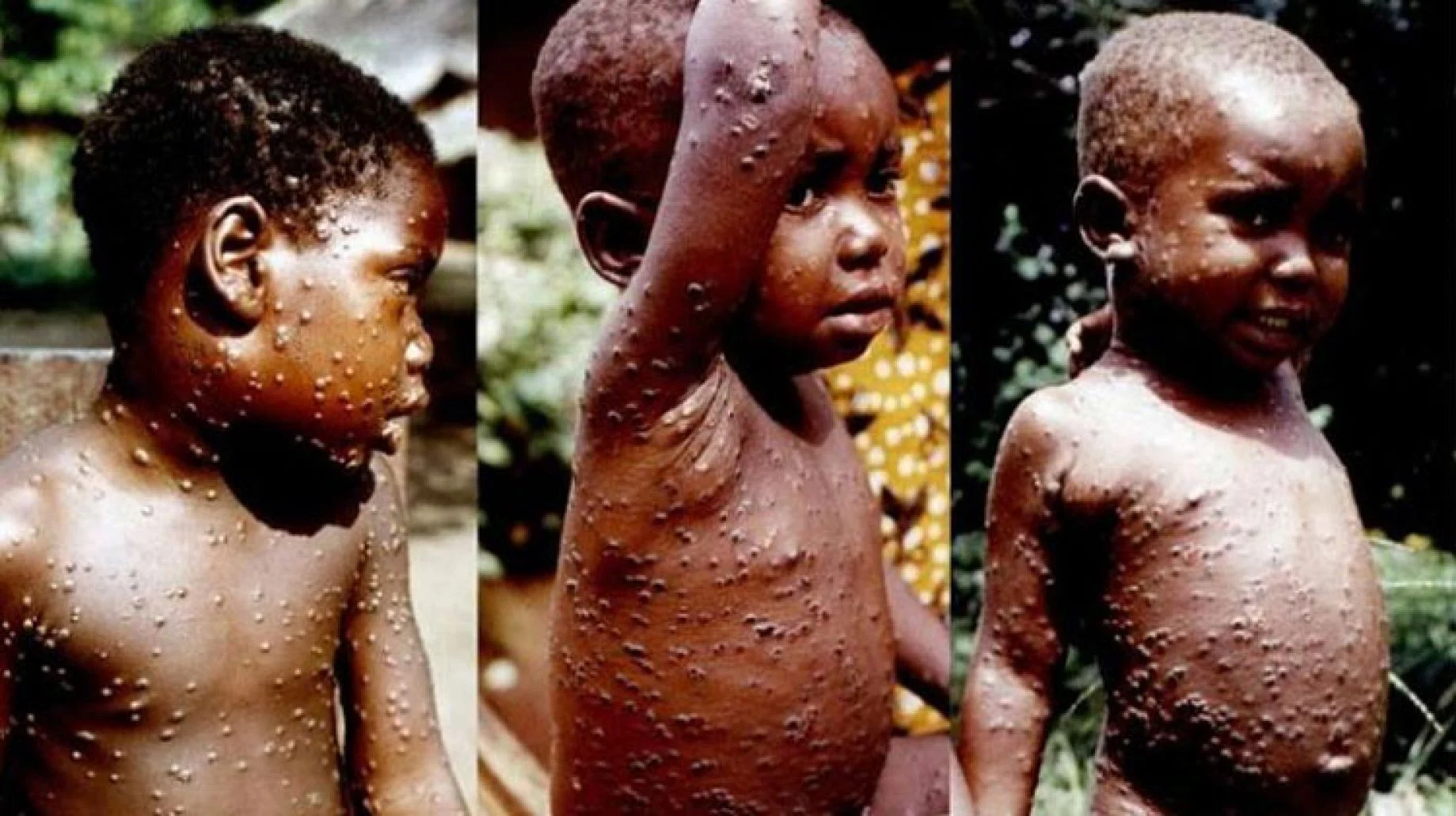 جدري القرود في افريقيا