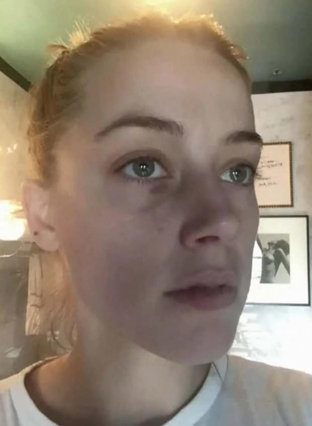 صورة لأمبر هيرد بعد الهجوم المزعوم من جوني ديب عليها