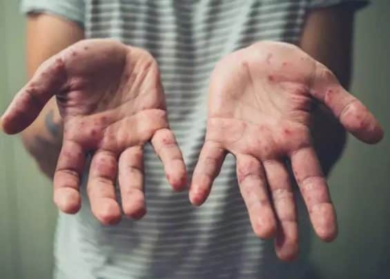 جدري القرود watanserb.com