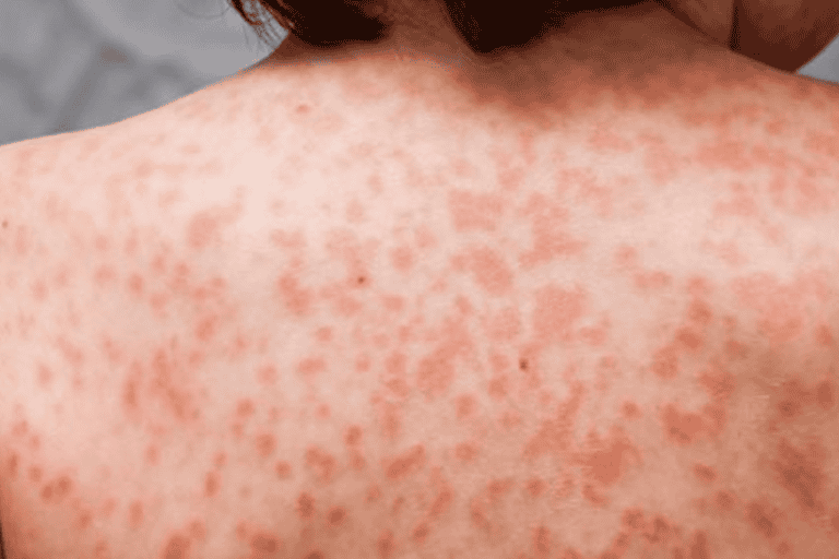 جدري القرود .. احذر هذه العلامة إذا ظهرت على وجهك علامات جدري القرود watanserb.com