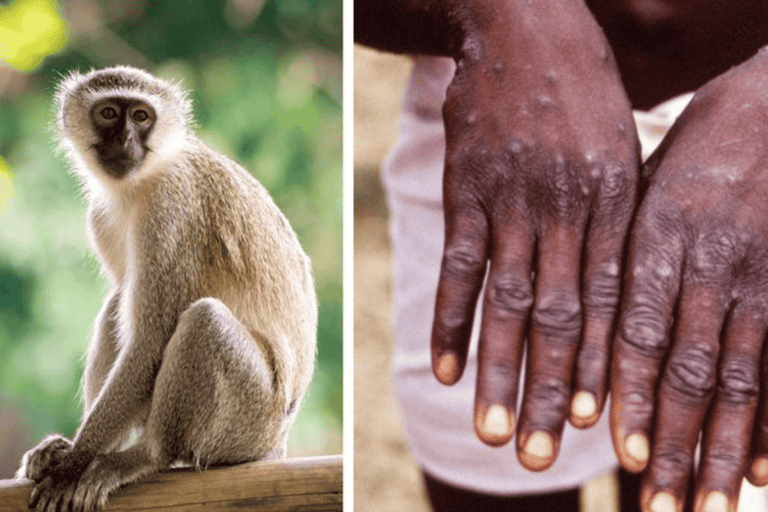 جدري القرود يفتك بالمثليين.. تخوفات من انتقاله للخليج فهل تمنع قطر حضورهم لكأس العالم؟ جدري القرود يفتك بالمثليين watanserb.com