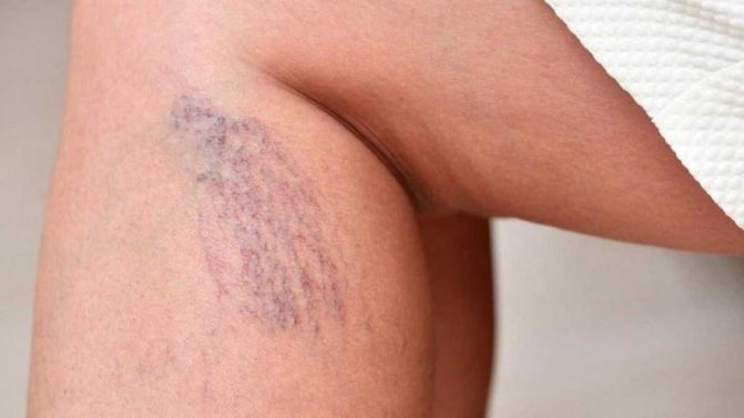 التخثر مرض صامت watanserb.com