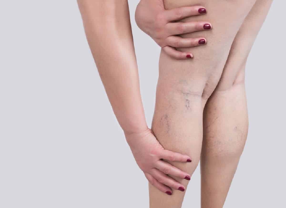   الجلطة في الأساس جلطة دموية، يحدث تكوينها في وعاء دموي أو في الوريد أو في الشريان.