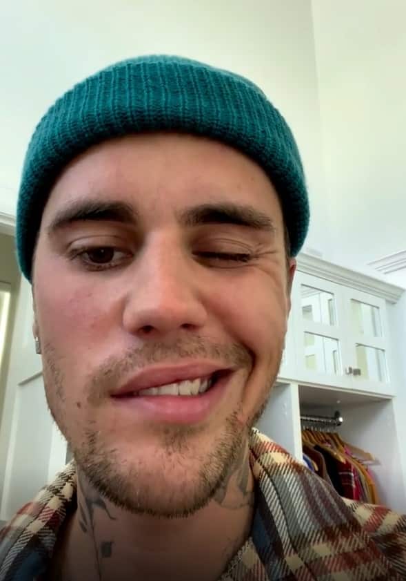 جاستن بيير مصاب بشلل في وجهه