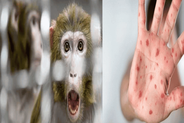 جدري القرود في السعودية. watanserb.com