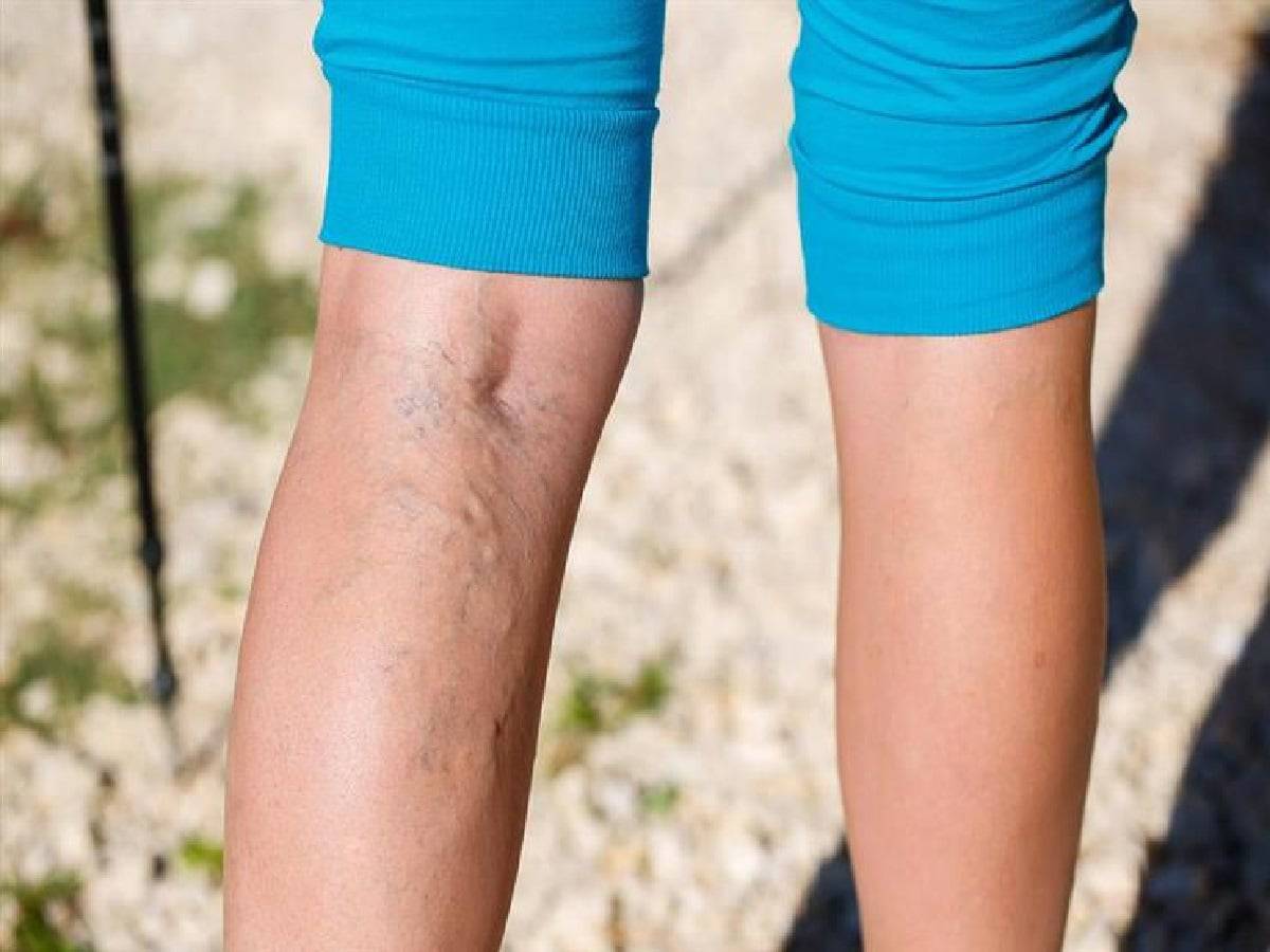 لا ينصح بوضع ساق على ساق عند الجلوس لمن يعانون من مرض الدوالي