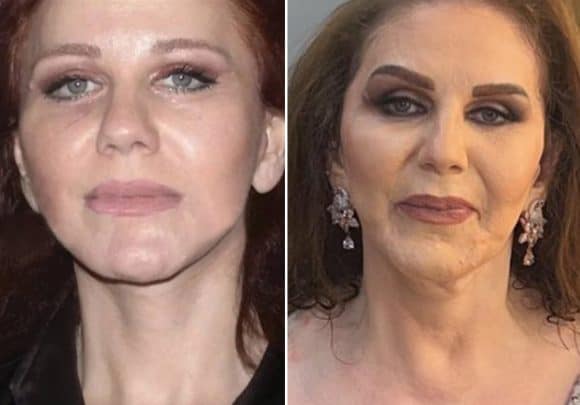ميادة الحناوي تكشف مفاجأة حول صور عملية التجميل التي نشرها نادر صعب لها! (فيديو) watanserb.com