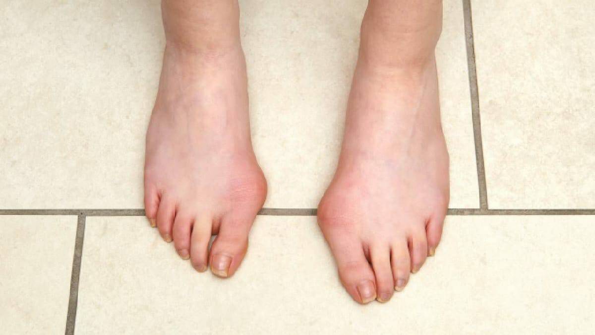 ما سبب ظهور الأورام في القدمين وكيف يمكن علاجها؟ تورّم الأقدام watanserb.com