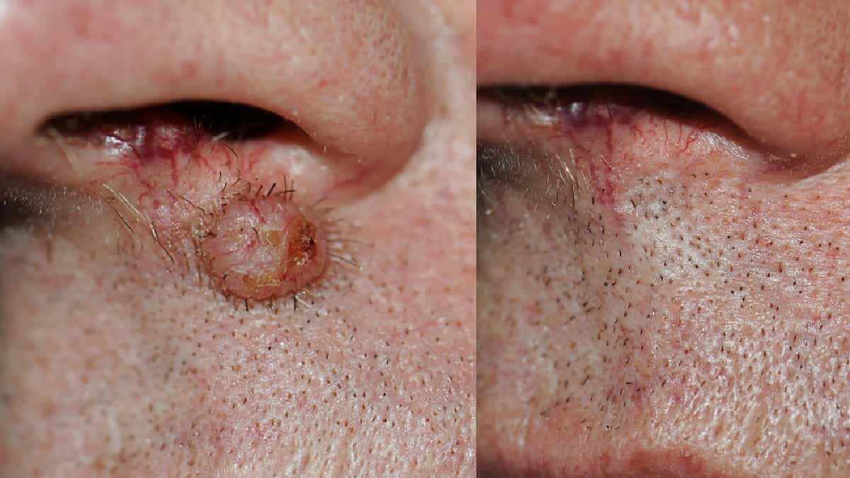 حُدّد ما يصل إلى 12 نوعًا فرعيًا مختلفًا من الفيروس