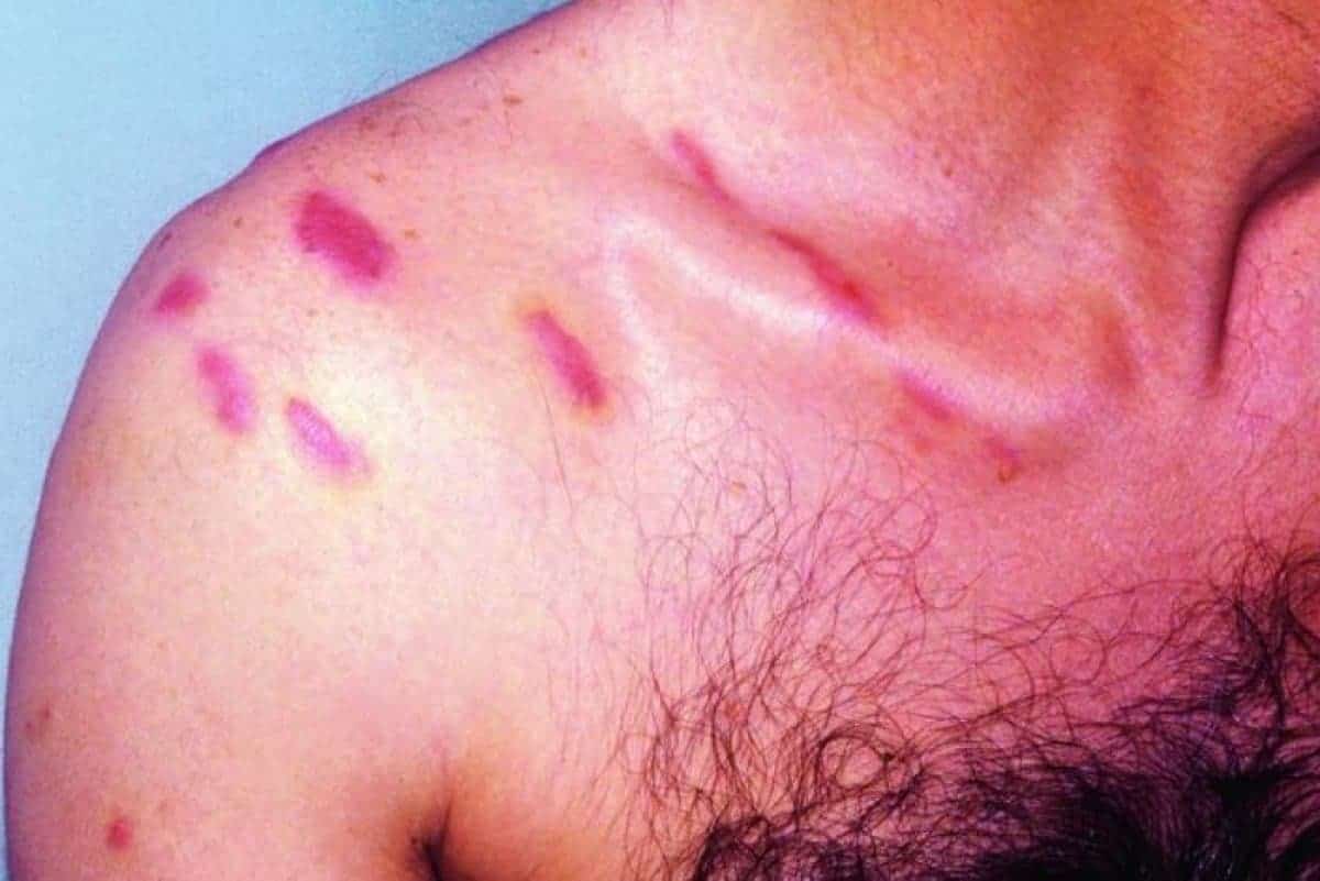 مرض ساركوما كابوسي.. فيروس صامت ونوع من أمراض السرطان