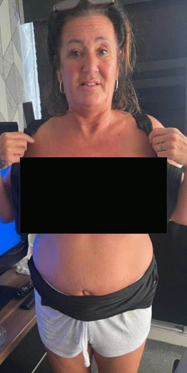 عملية تكبير أثداء فاشلة