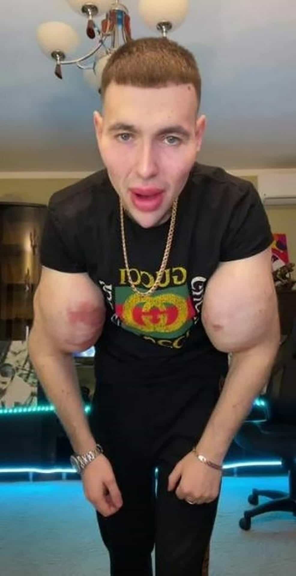 وجهه تأثر أيضا جراء استخدام المنشطات