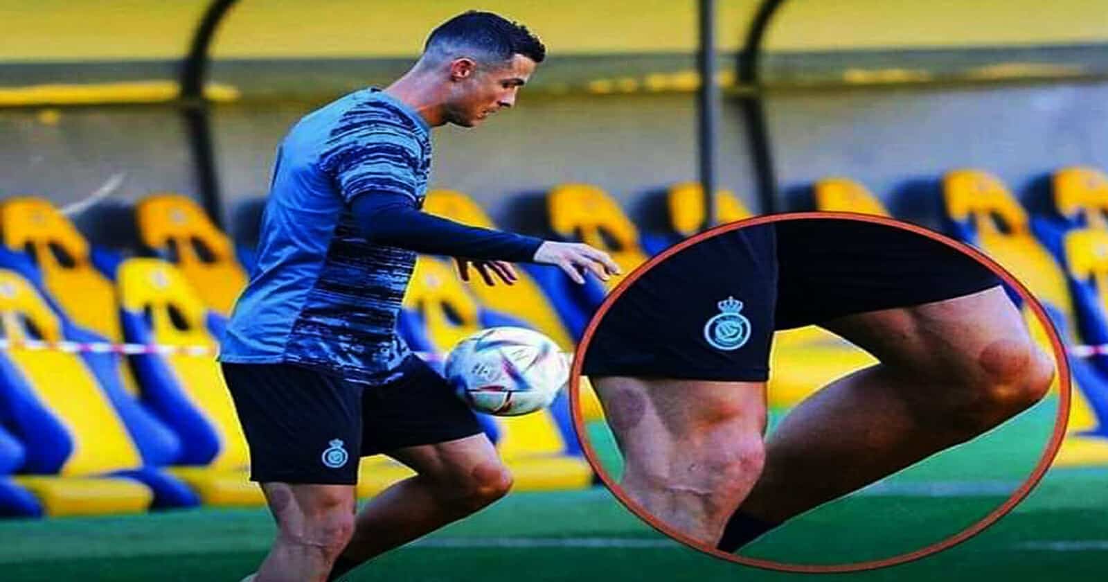 بعد ارتداء الجلابية وحمل السيف.. رونالدو يخضع للعلاج بالحجامة (صور) حجامة رونالدو watanserb.com