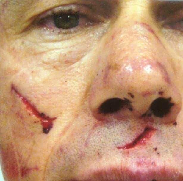 اصابة الغواص بعد هجوم سمكة القرش عليه