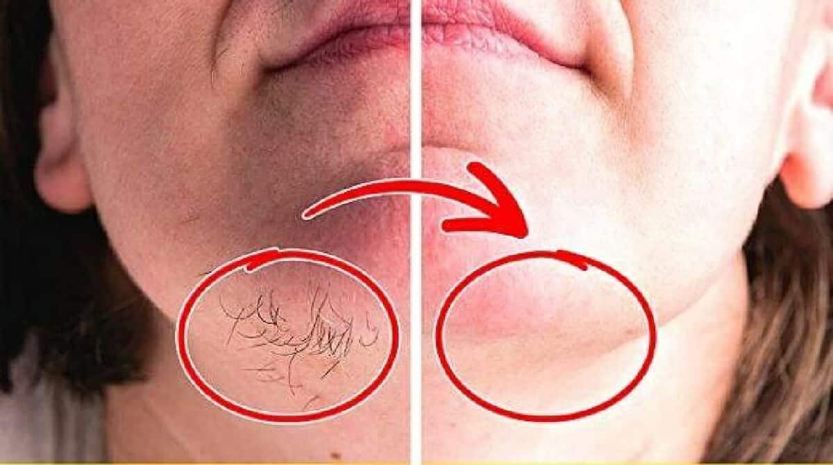 أسباب ظهور الشعر على ذقن النساء وطرق فعالة للتخلص منه بفعالية. ظهور الشعر في ذقن المرأة watanserb.com