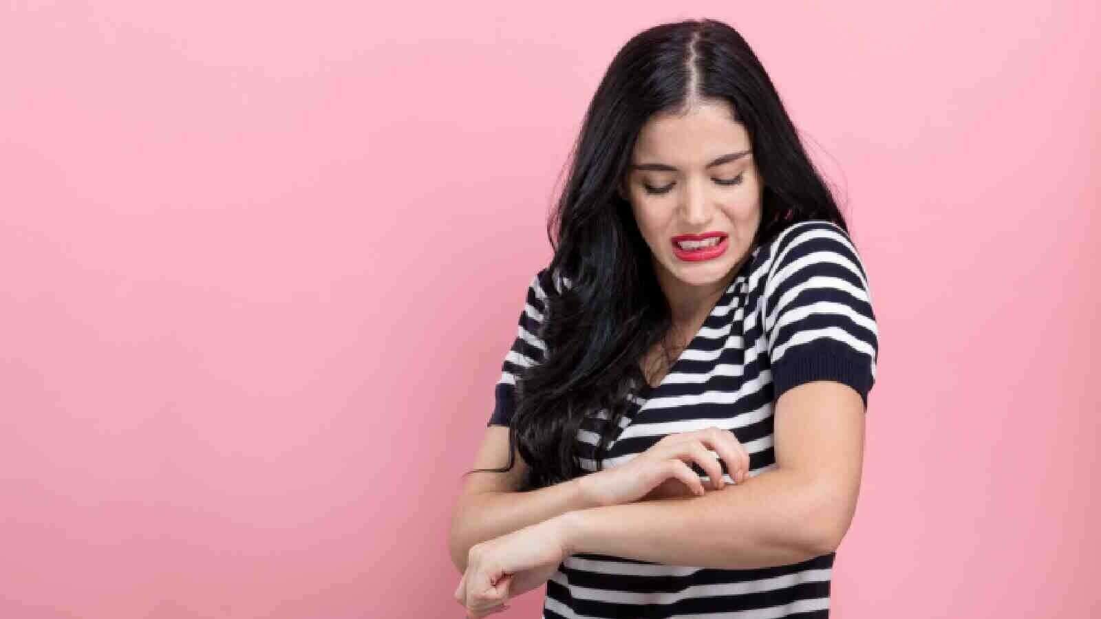 لدغات البعوض