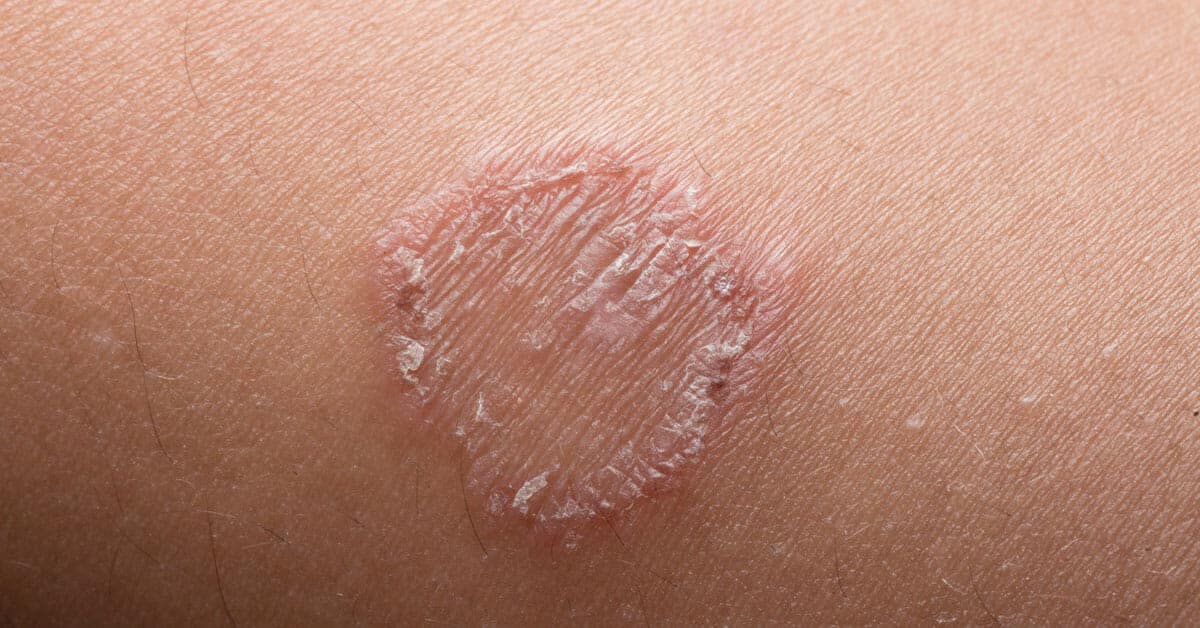 أعراض عدوى السعفة المقاومة للأدوية