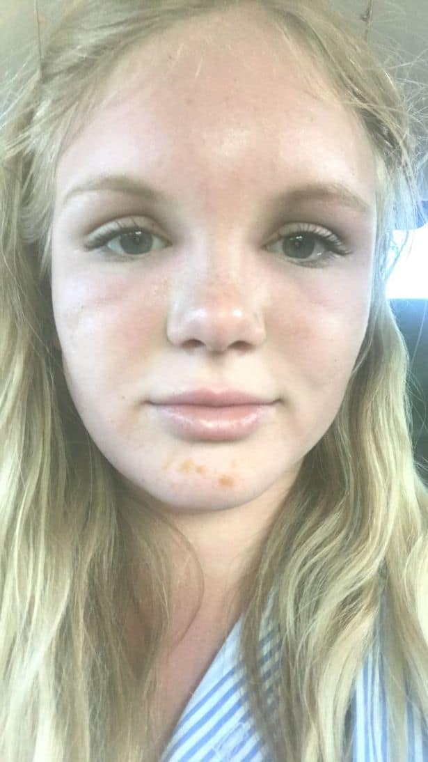 التسمم الشمسي