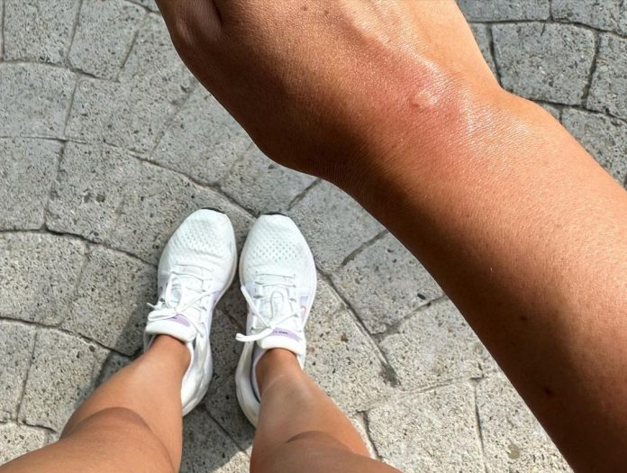 لدغة جورجينا من النحلة