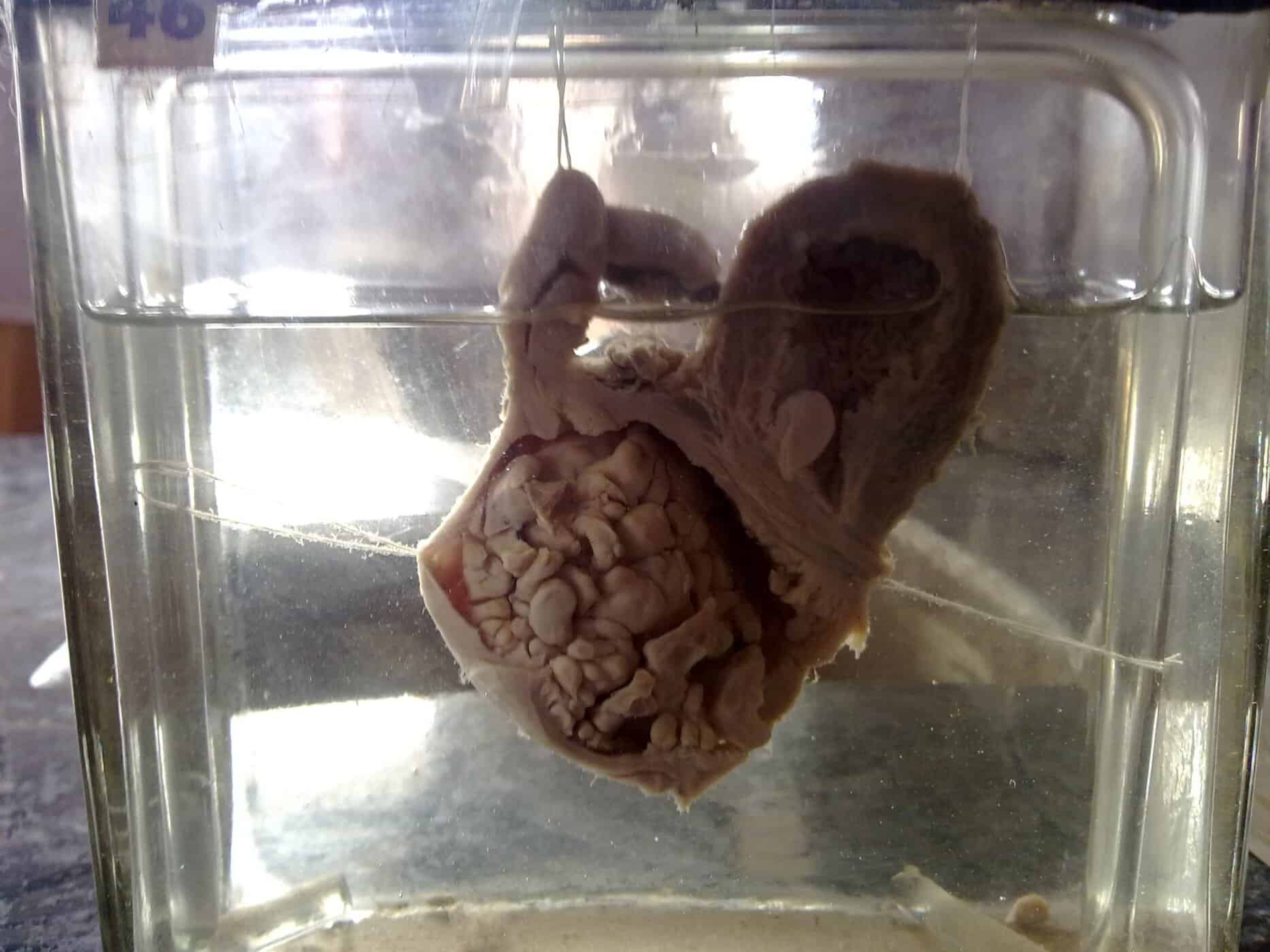 سرطان المهبل