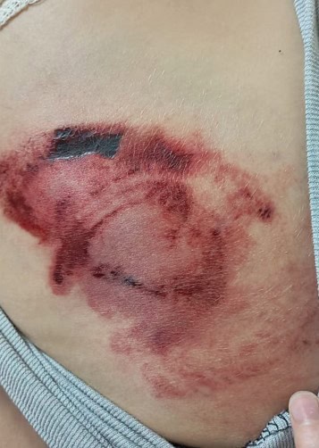 عضة حصان تصيب طفلا أردنيا بمرض غامض