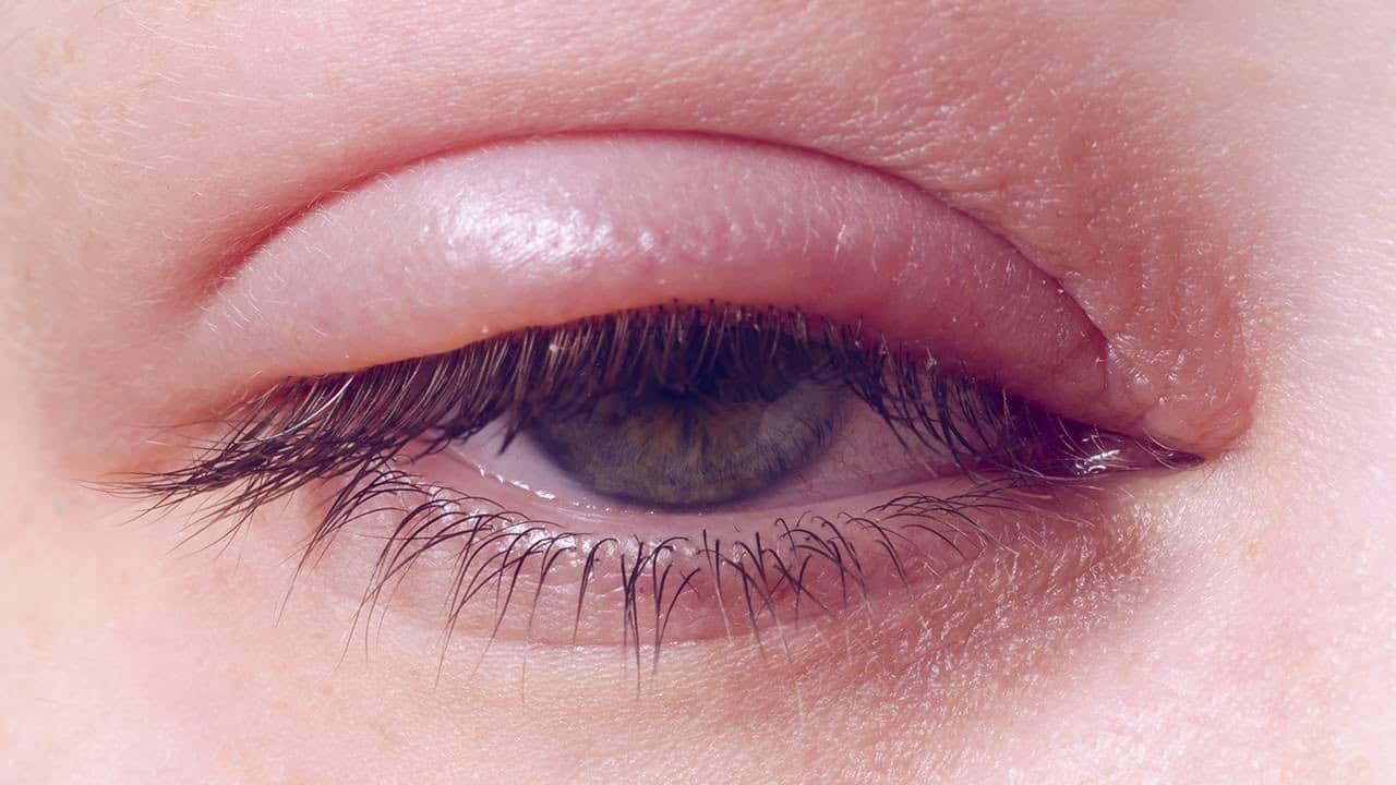 التهاب الجفون وتورّمها