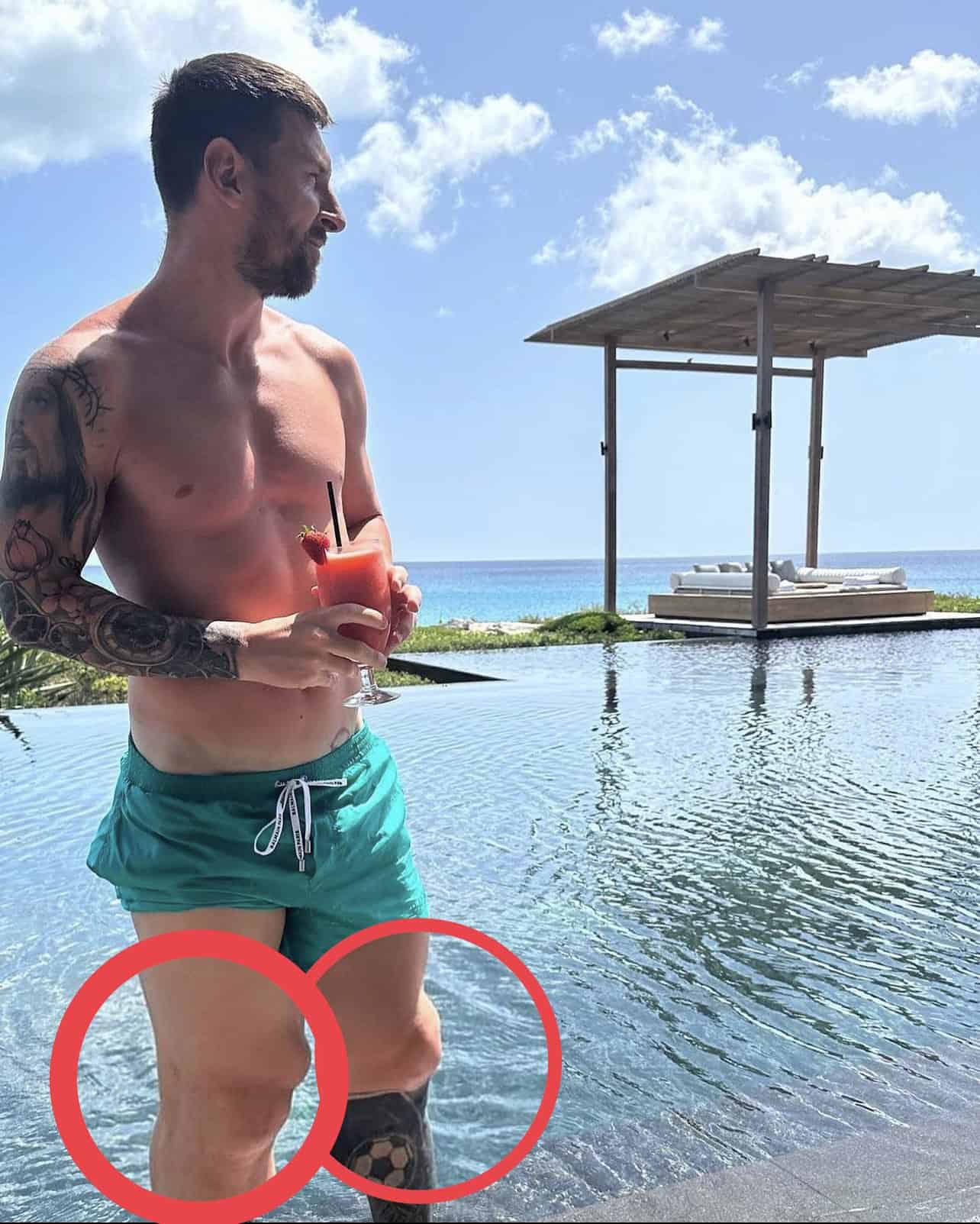 تورم في ركبة ميسي