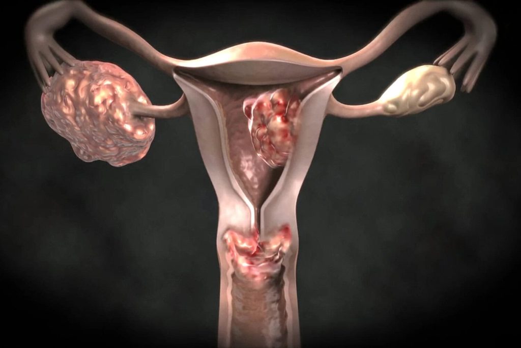 سرطان الرحم