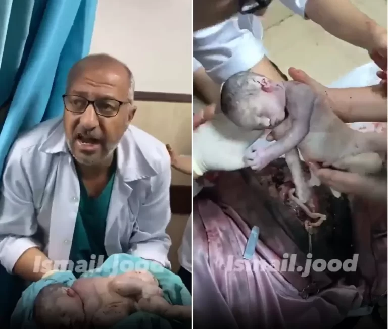 لحظة إخراج جنين من بطن والدته الشهيدة في غزة.. فيديو يُدمي القلب اخراج جنين من بطن والدته الشهيدة