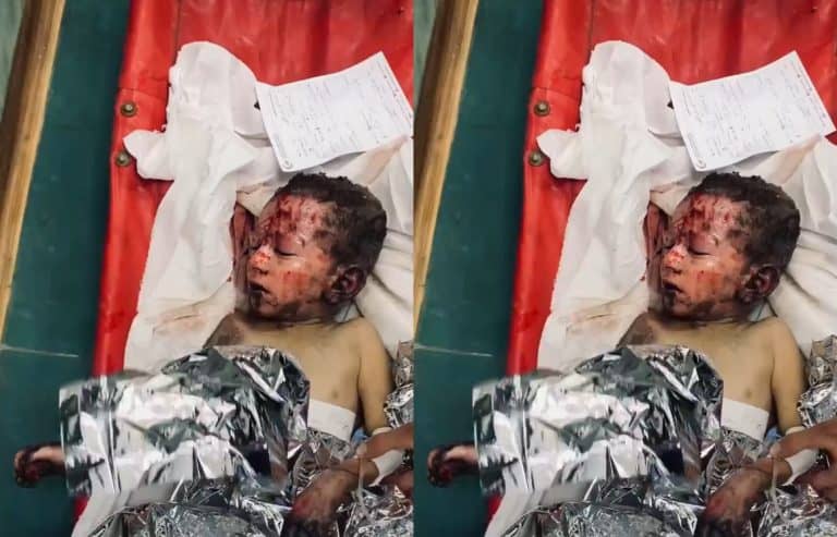 طفل فلسطيني جسده محروق جراء صواريخ الاحتلال
