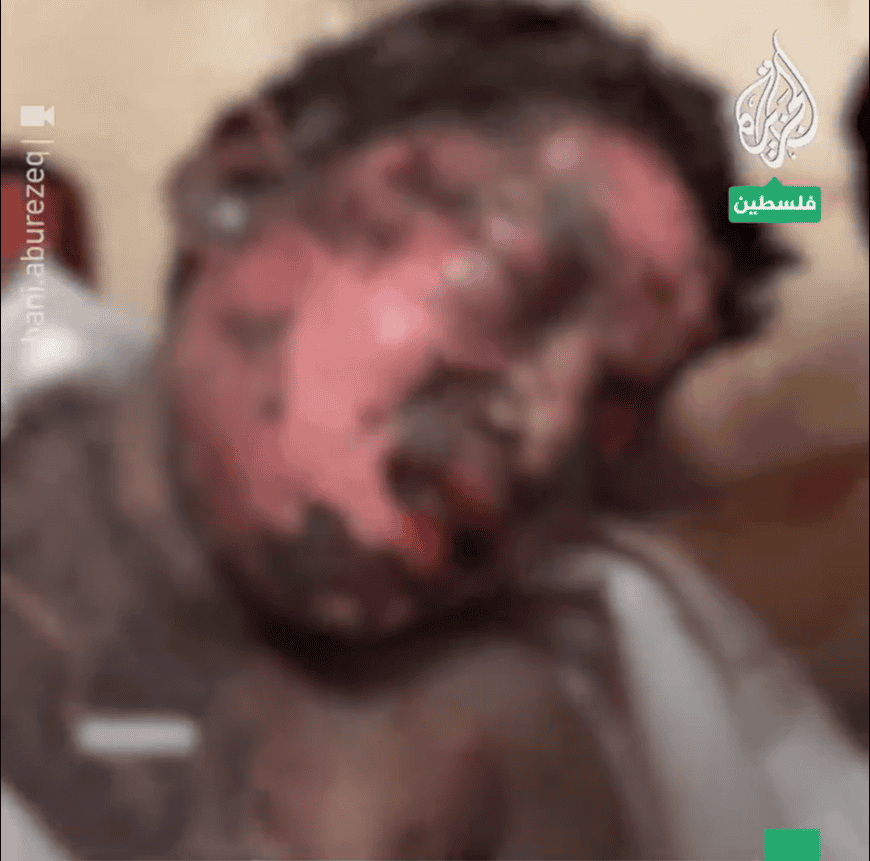 أطفال غزة يعانون الألم والمعاناة جراء قصف إسرائيلي يستهدف منازلهم في القطاع طفل فلسطيني شوهت الحروق جسمه