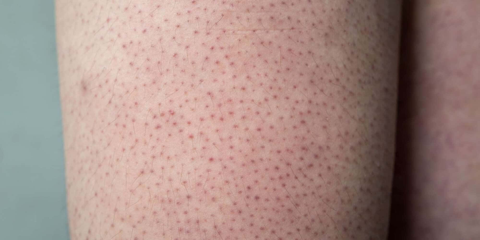 تقرن الشعر أو جلد الدجاج