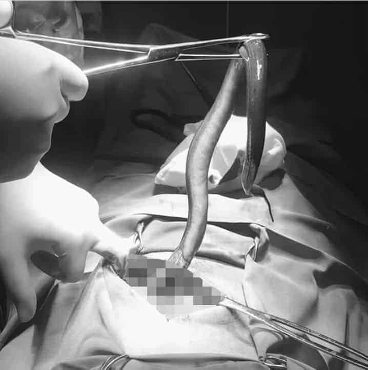 أزال الأطباء في فيتنام ثعبان بحر حي بطول 30 سم من بطن رجل