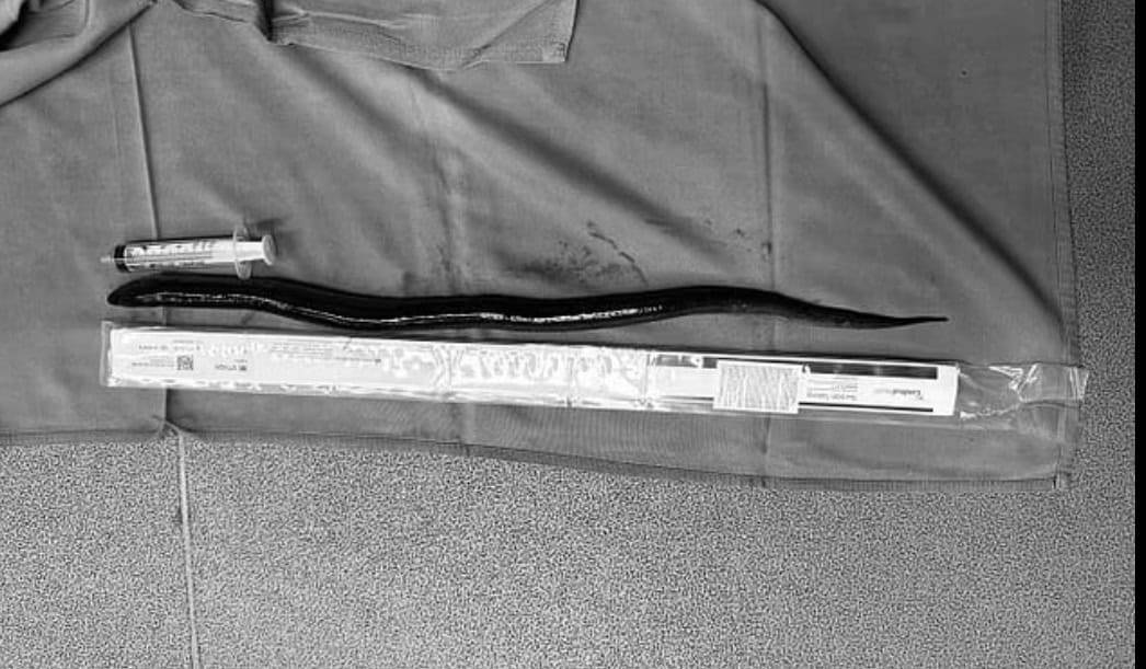 ثعبان البحر الذي اخرج من بطن الرجل بطول مسطرة قياسية