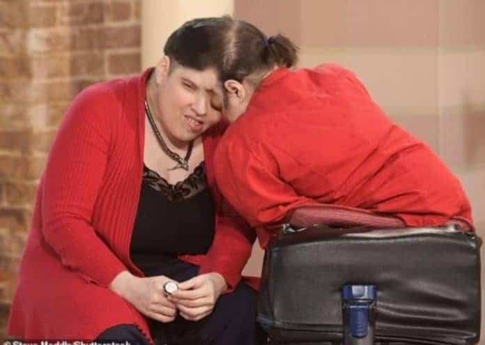 وفاة أكبر توأم ملتصق في العالم