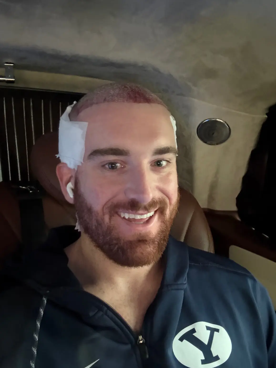 انتشرت صور عملية زراعة الشعر التي أجراها كينيون في تركيا بشكل كبير على وسائل التواصل الاجتماعي.